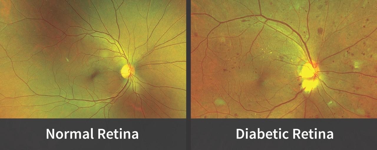 Diabetic eye disease awareness